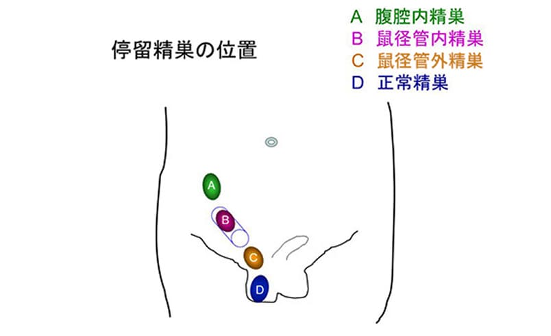 停留精巣・移動性精巣